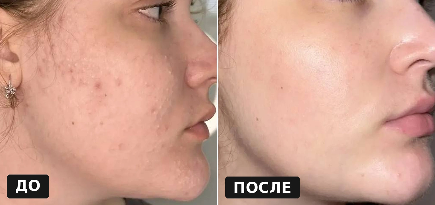 Результат лечения закрытых комедонов: до и после